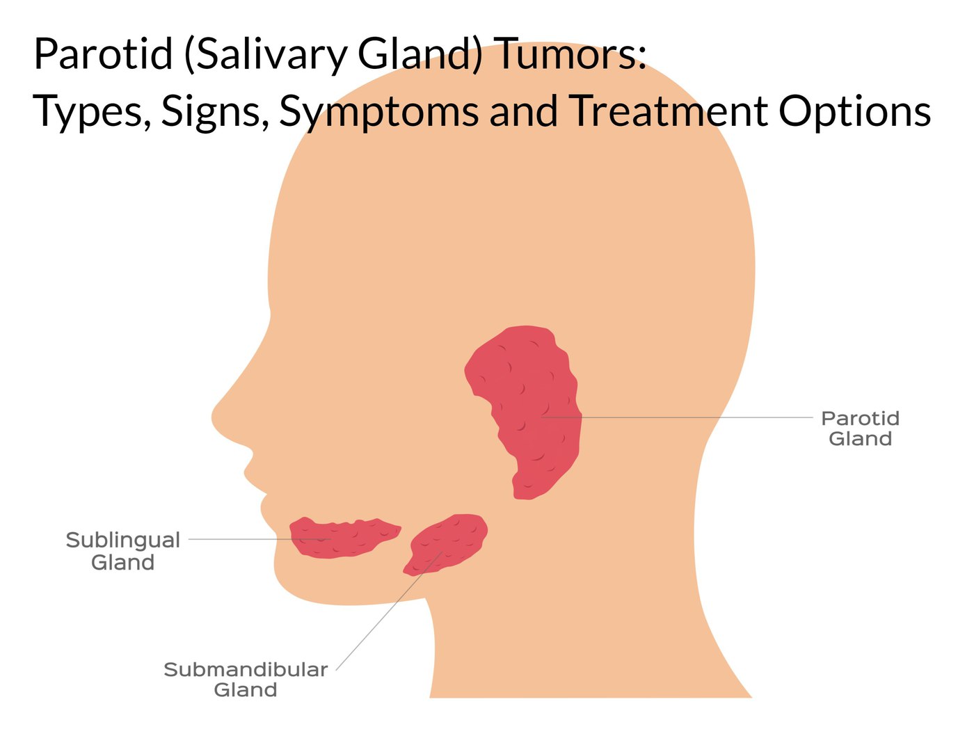 Parotid (Salivary Gland) Tumors Types, Symptoms, and Treatments